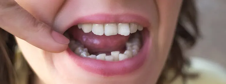 7 Things that cause crooked teeth