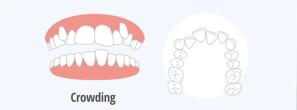 crowding of the mouth