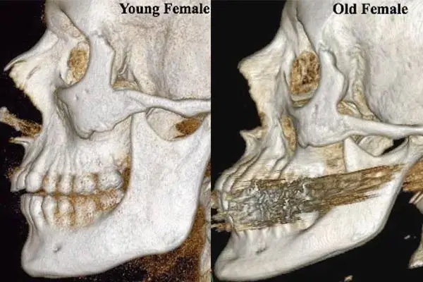 Why do teeth shift as we age?