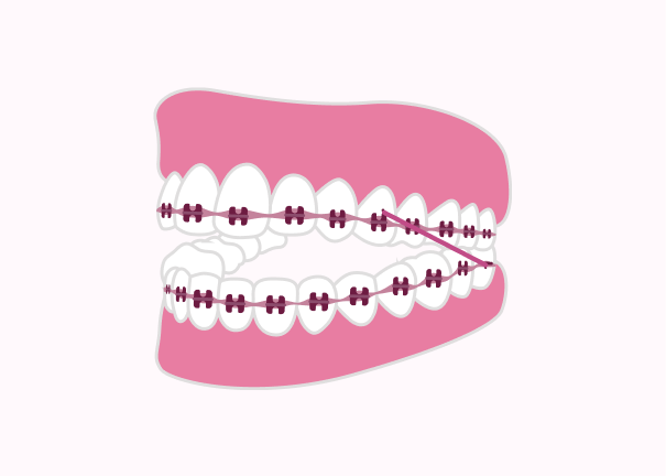 Pink teeth with braces illustration for Atlanta orthodontic website