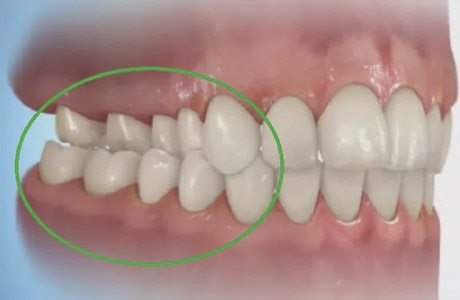 Crossbite