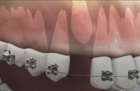 Impacted Teeth