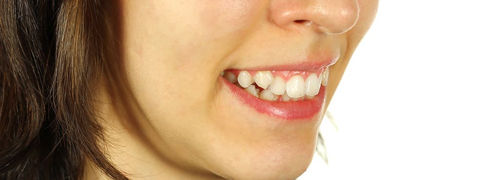 woman with crooked teeth
