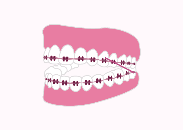 Pink teeth with braces illustration for Atlanta orthodontic website